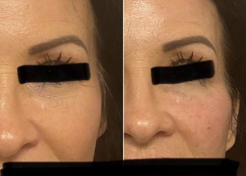 before-after-filler-1-768x552