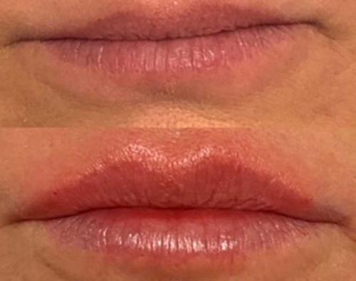 before-after-filler-2-768x606
