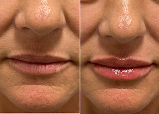 before-after-filler-3