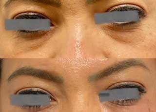before-after-filler-4