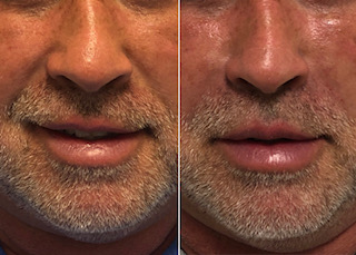 before-after-filler-5