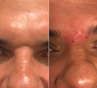 before-after-filler-6