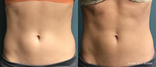 evolve-before-after-dr-j-stubbs-preview-1