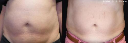 evolve-before-after-dr-t-shimer-preview-2