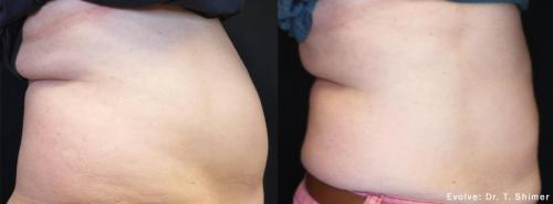 evolve-before-after-dr-t-shimer-preview-3